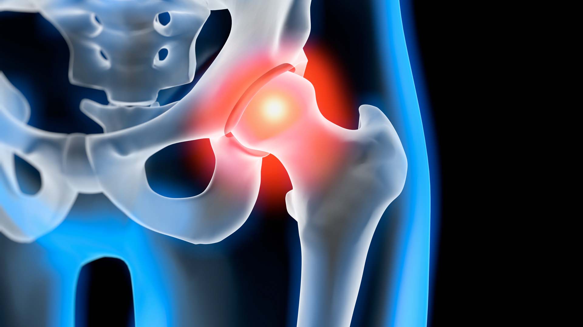 Impingement Hüfte