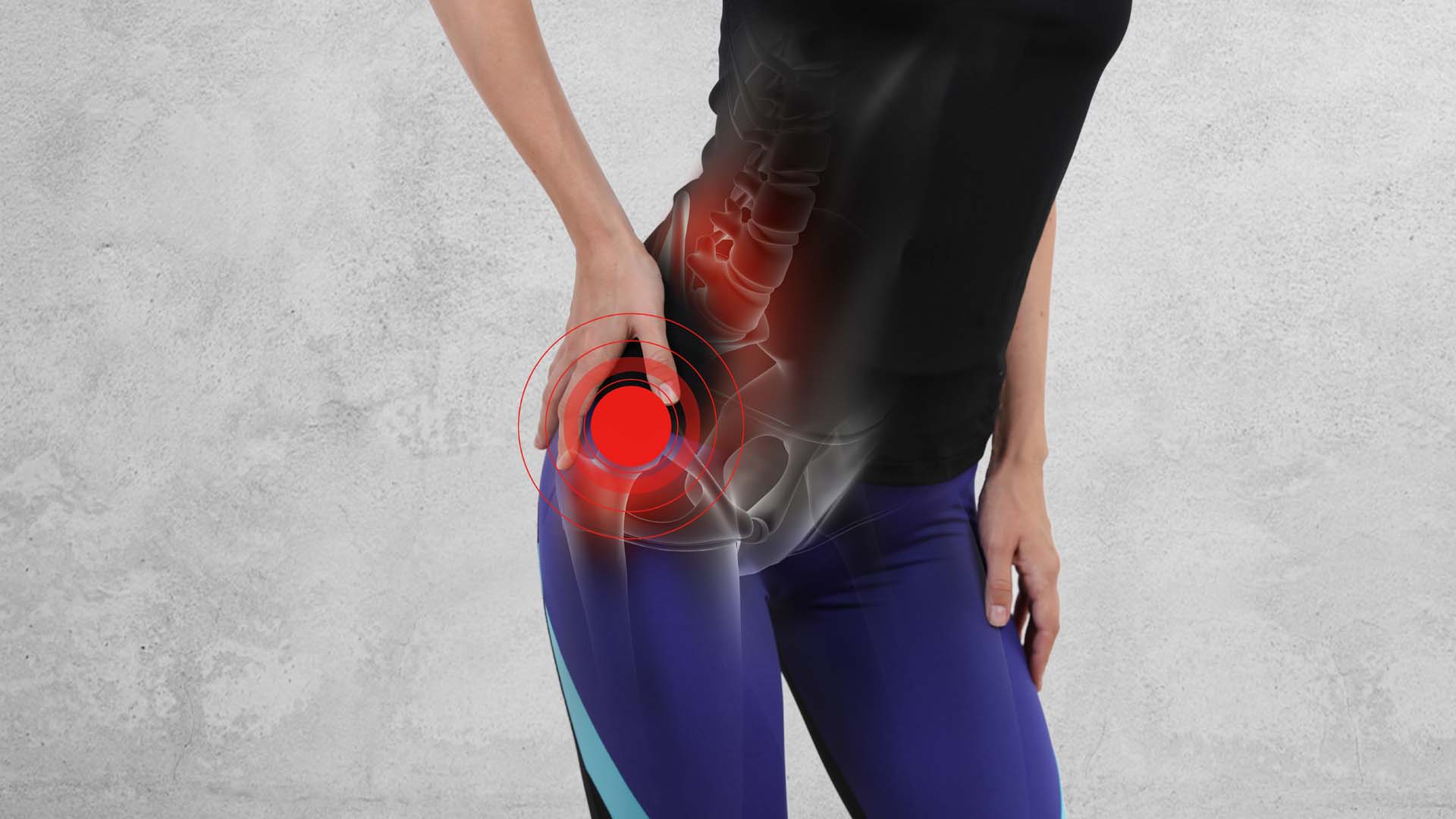 Bursitis Trochanterica & Muskelüberlastung
